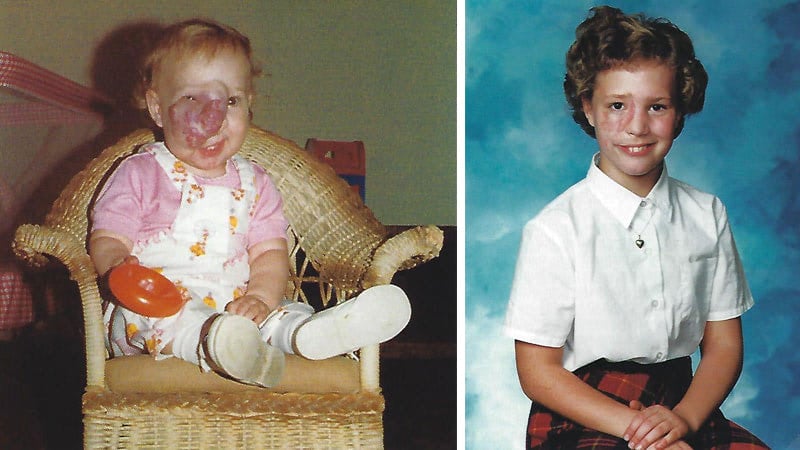 Images of Jennifer Wallace's face showing her hemangioma at 11 months and after skin graft surgery in the fourth grade