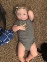 One-Year-Old Boy born with the craniofacial condition Nager Syndrome