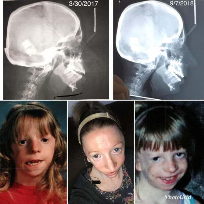 Treacher Collins Syndrome